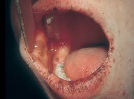 Hội chứng Peutz–Jeghers - Hình ảnh minh họa